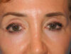 Blepharoplasty case #5901