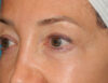 Blepharoplasty case #5901