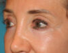 Blepharoplasty case #5901