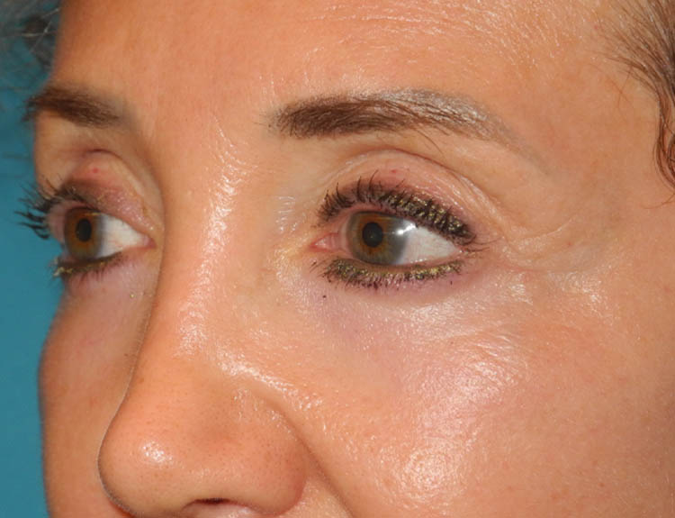 Blepharoplasty case #5901