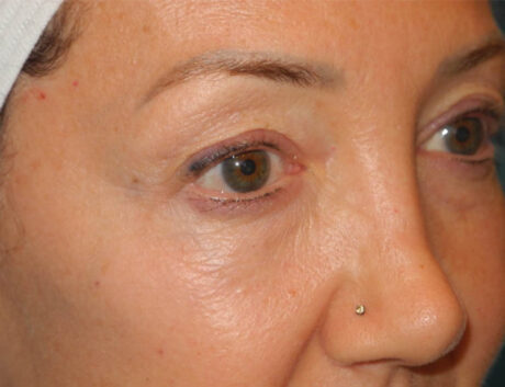 Blepharoplasty case #5901