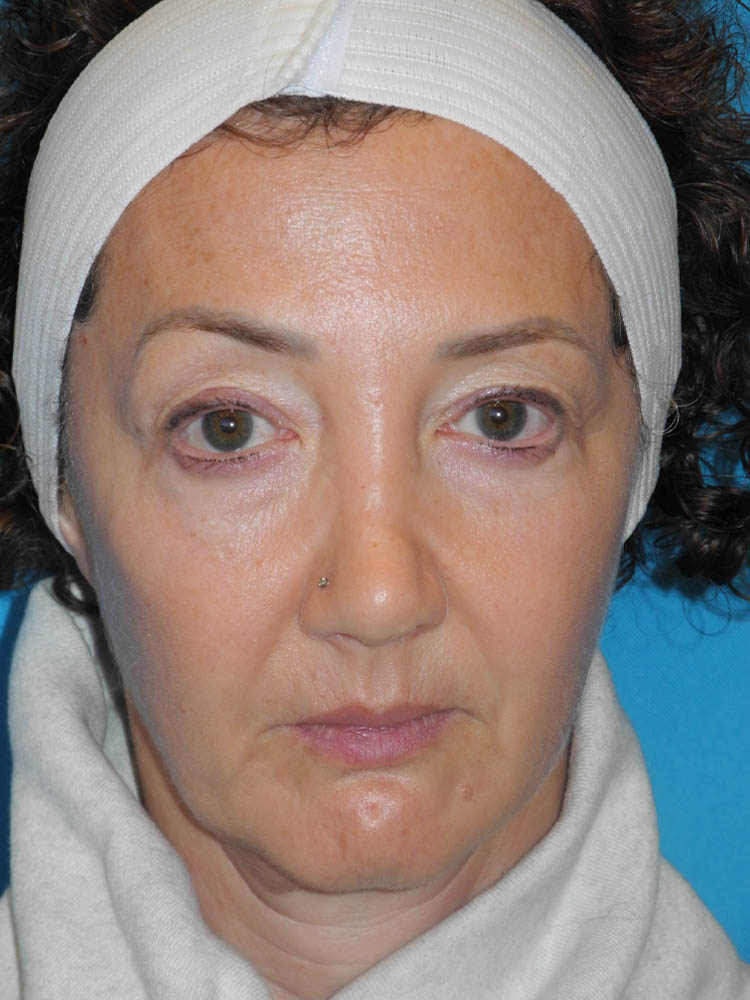 Blepharoplasty case #5901