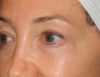 Blepharoplasty case #6462