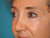 Blepharoplasty case #5901