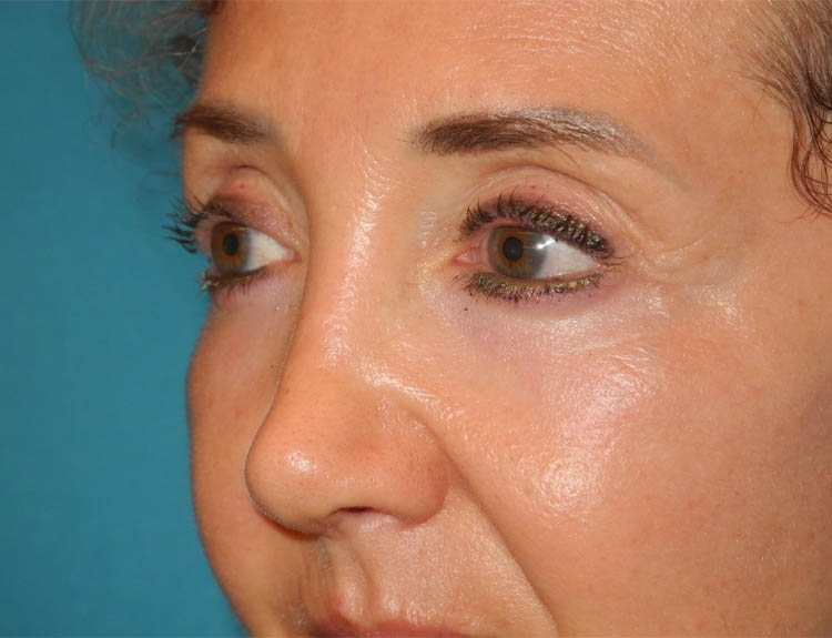 Blepharoplasty case #5901