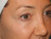 Blepharoplasty case #6462