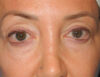 Blepharoplasty case #5901