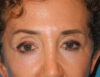 Blepharoplasty case #6462