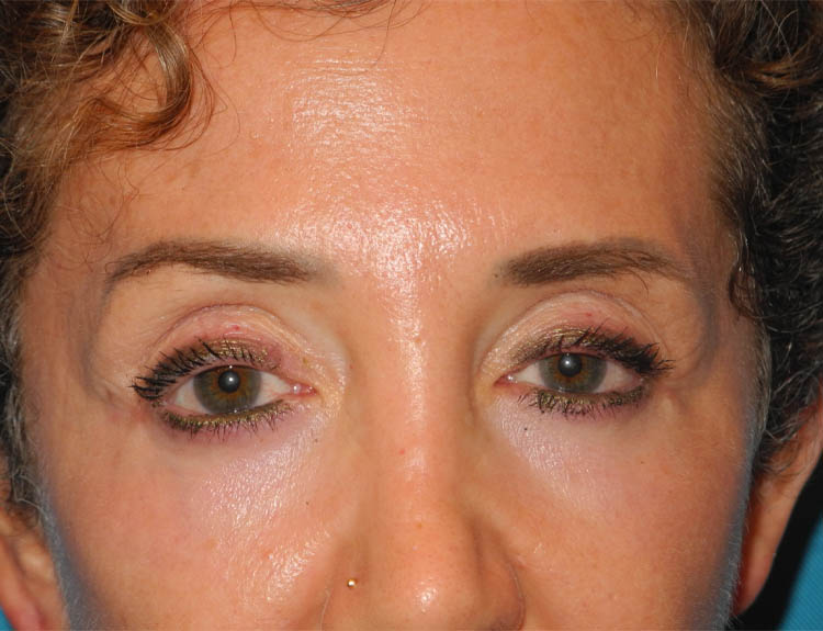 Blepharoplasty case #5901