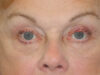 Blepharoplasty case #5963