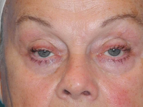 Blepharoplasty case #5963