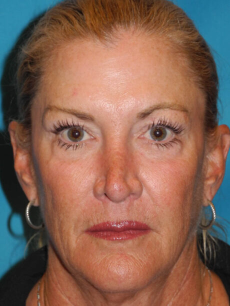 Brow Lift case #5063
