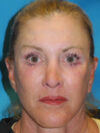 Brow Lift case #5063