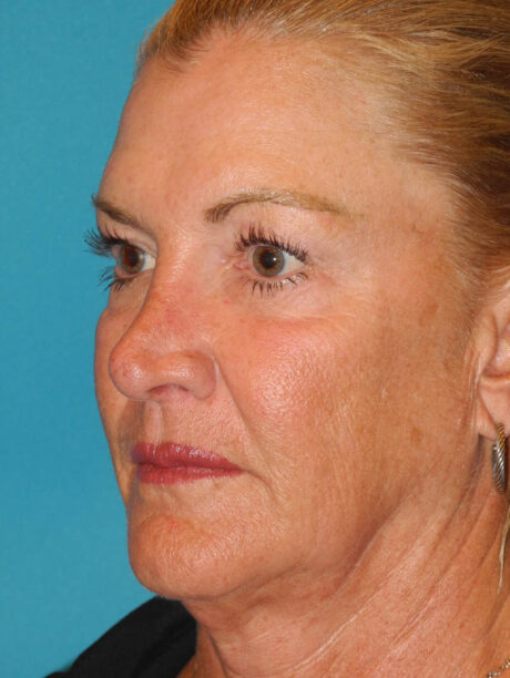 Brow Lift case #5063