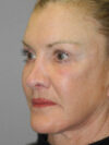 Brow Lift case #5063