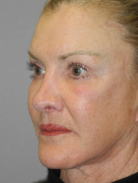 Brow Lift case #5063