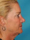 Brow Lift case #5063