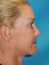 Brow Lift case #5063
