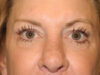 Brow Lift case #5063