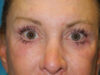 Brow Lift case #5063