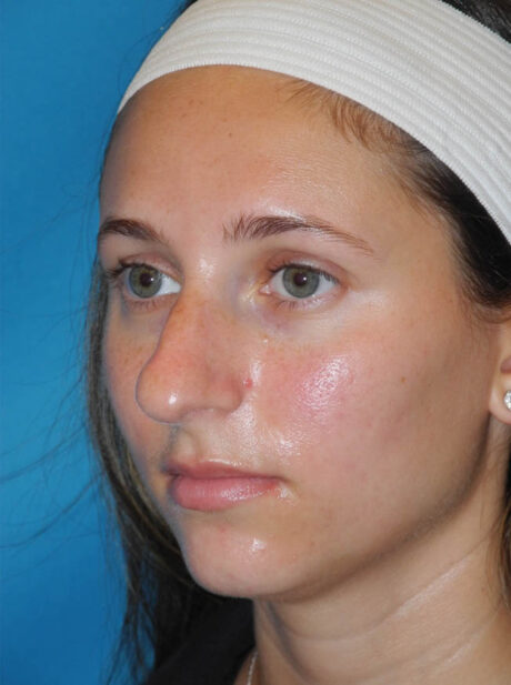 Rhinoplasty case #6270