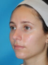 Rhinoplasty case #6270