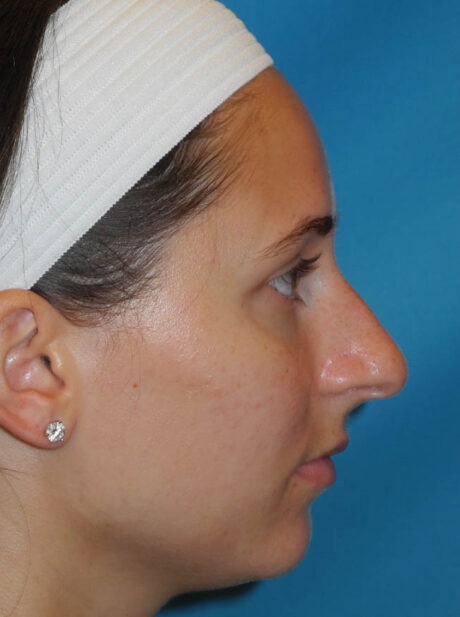 Rhinoplasty case #6270