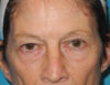 Blepharoplasty case #6364