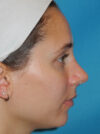 Rhinoplasty case #6270