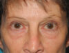 Blepharoplasty case #6364