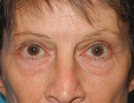 Blepharoplasty case #6364