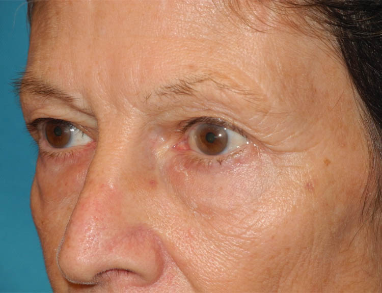 Blepharoplasty case #6364