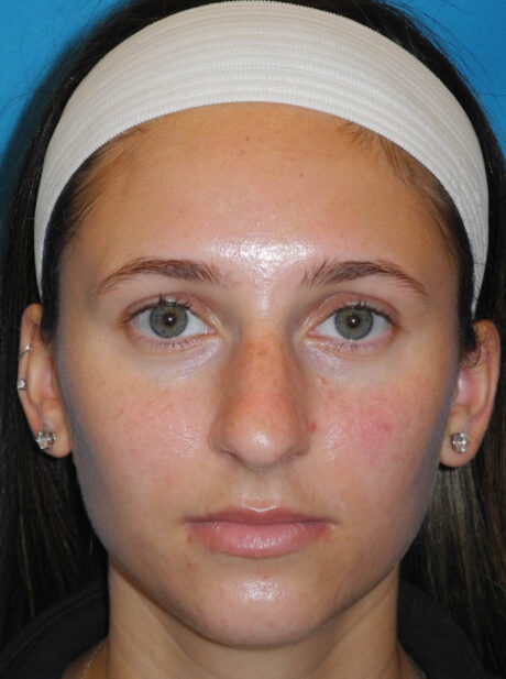 Rhinoplasty case #6270