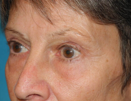 Blepharoplasty case #6364