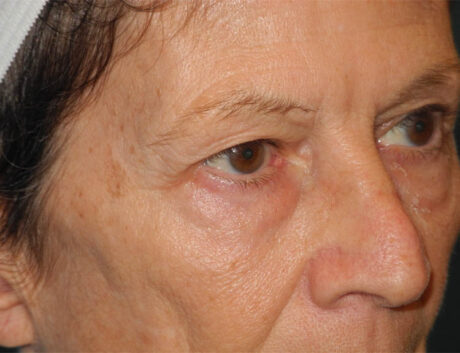 Blepharoplasty case #6364