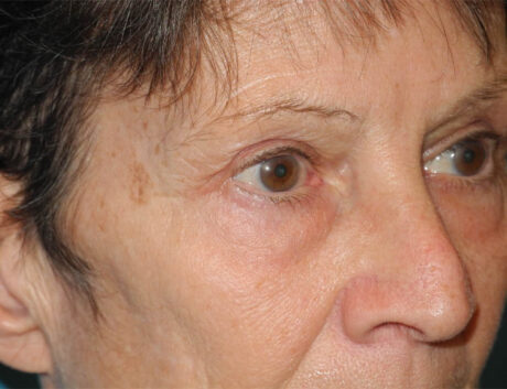 Blepharoplasty case #6364