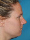 Rhinoplasty case #6279