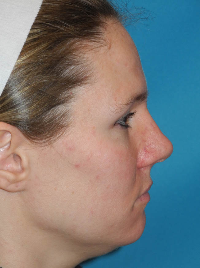 Rhinoplasty case #6279