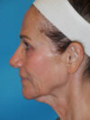 Facelift case #6427