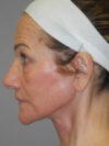 Facelift case #6427