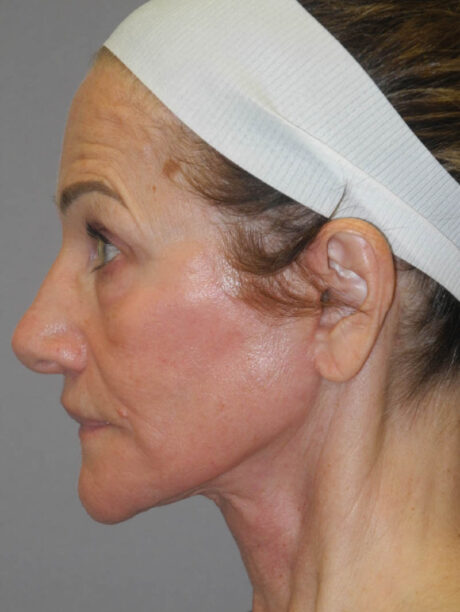 Facelift case #6427