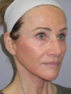 Facelift case #6427