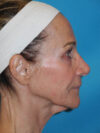 Facelift case #6427