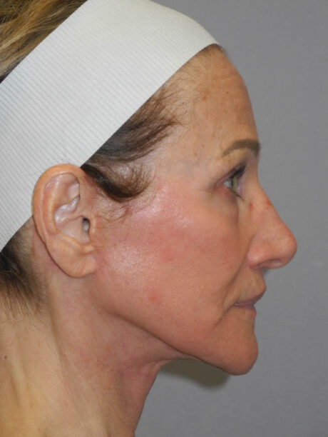 Facelift case #6427