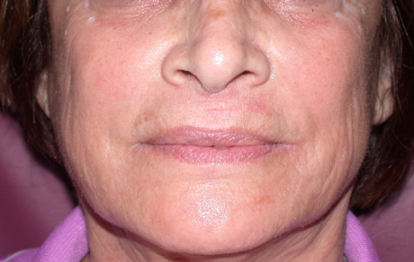 Dermal Fillers case #6618