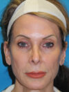 Brow Lift case #7010