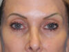 Blepharoplasty case #7017