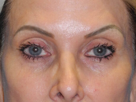 Blepharoplasty case #7017