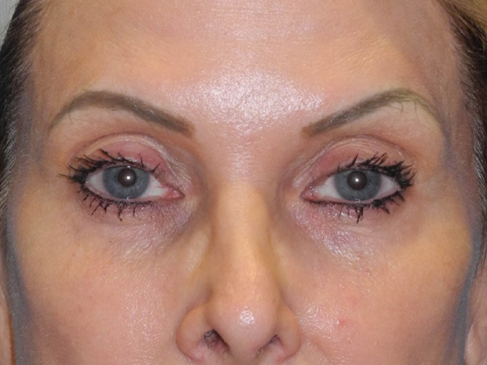 Blepharoplasty case #7017
