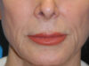 Lip Lift case #7003